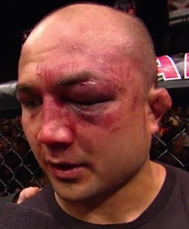 BJ Penn e seu olho roxo, cortesia da direita de Nick Diaz. Foto: UFC/Divulgação